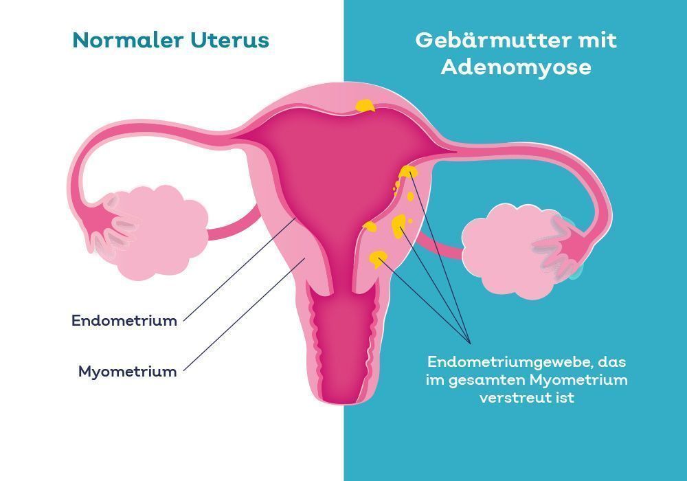 Infografik der Gebärmutter mit Adenomyose
