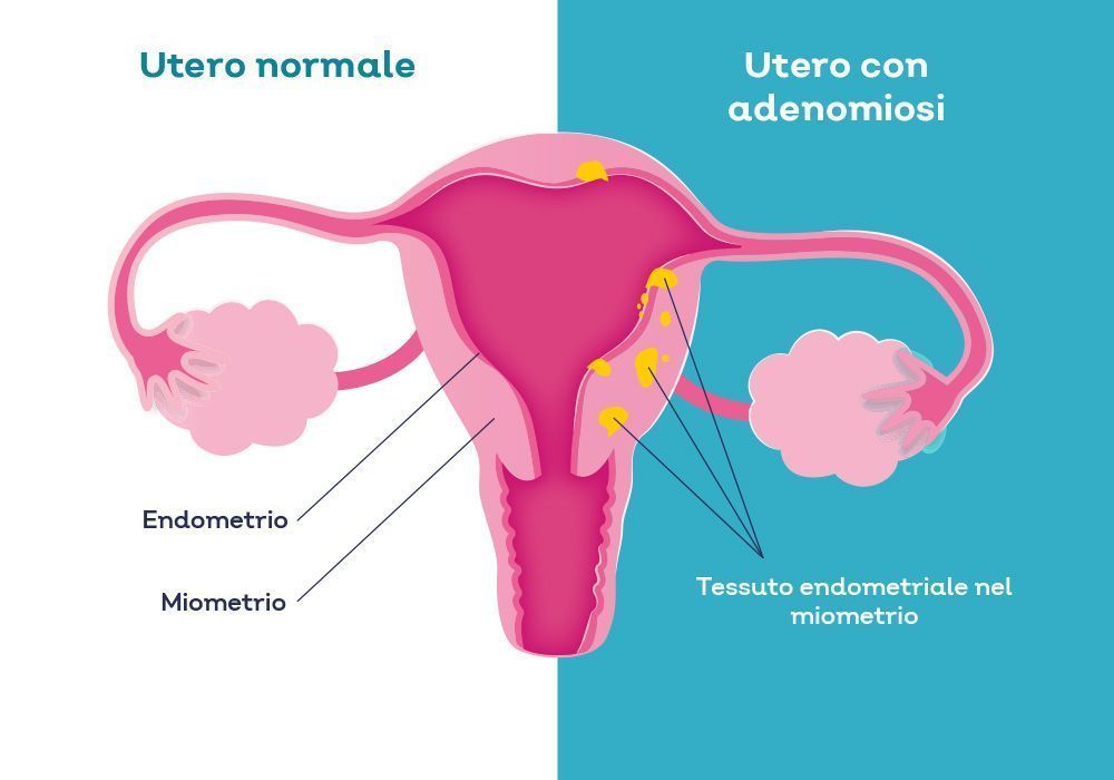 Infografica sull'adenomiosi