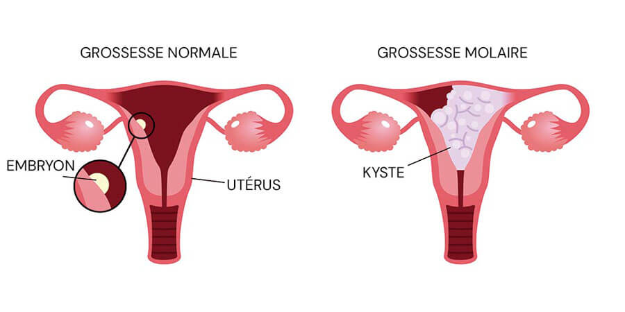 Infographie sur la grossesse molaire