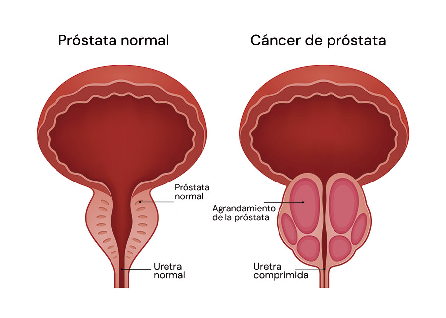 Infografía del cáncer de próstata