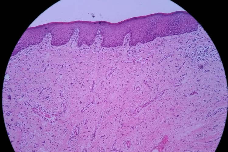 Umetokiko horma adenomiosiarekin
