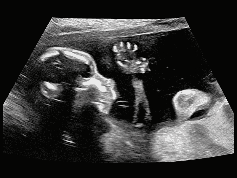 Ecografía bebe semana 20