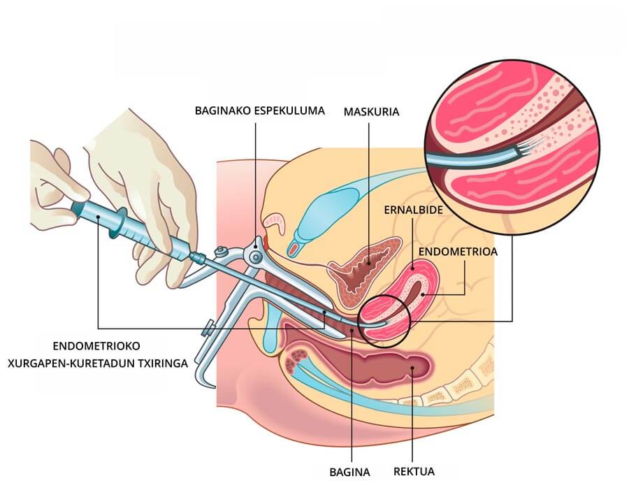 Endometrioko biopsiaren infografia