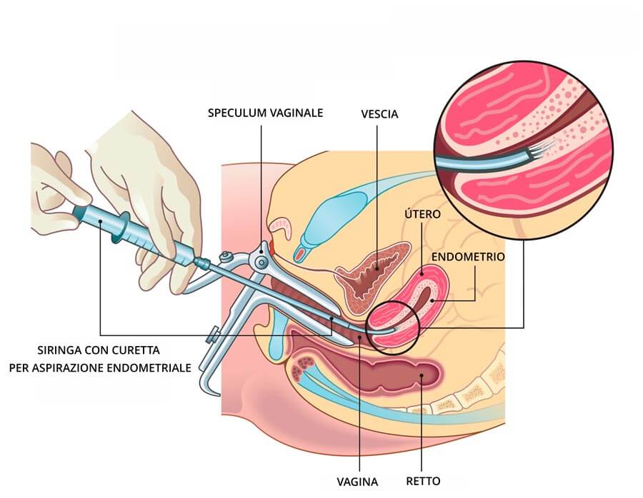 Infografica sulla biopsia endometriale