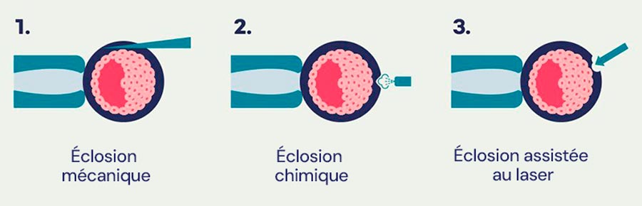 Infographie sur l'éclosion assistée