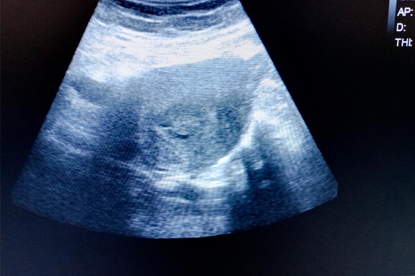 Endometrioko polipoak dituen paziente baten ultrasoinua