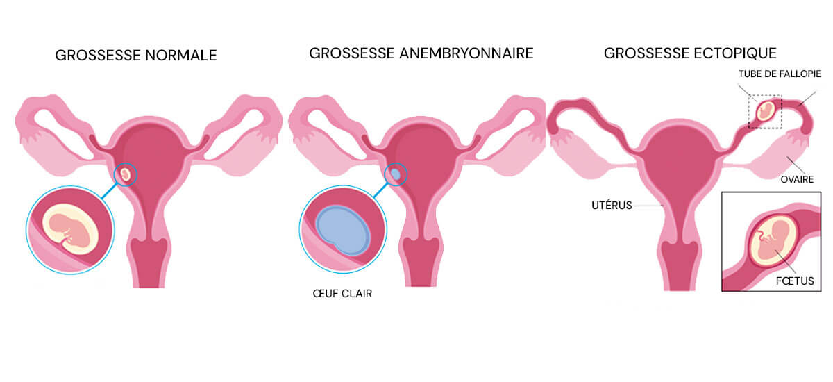 Infographie sur la grossesse anembryonnaire