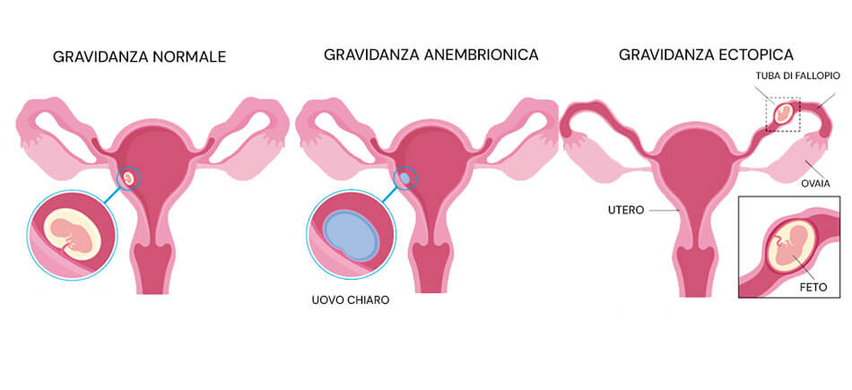 Infografica sulla gravidanza anembrionica