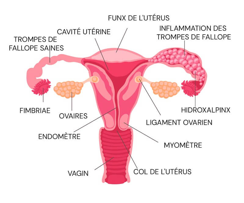 Infographie des trompes de Fallope et de l'hydroxalpinx