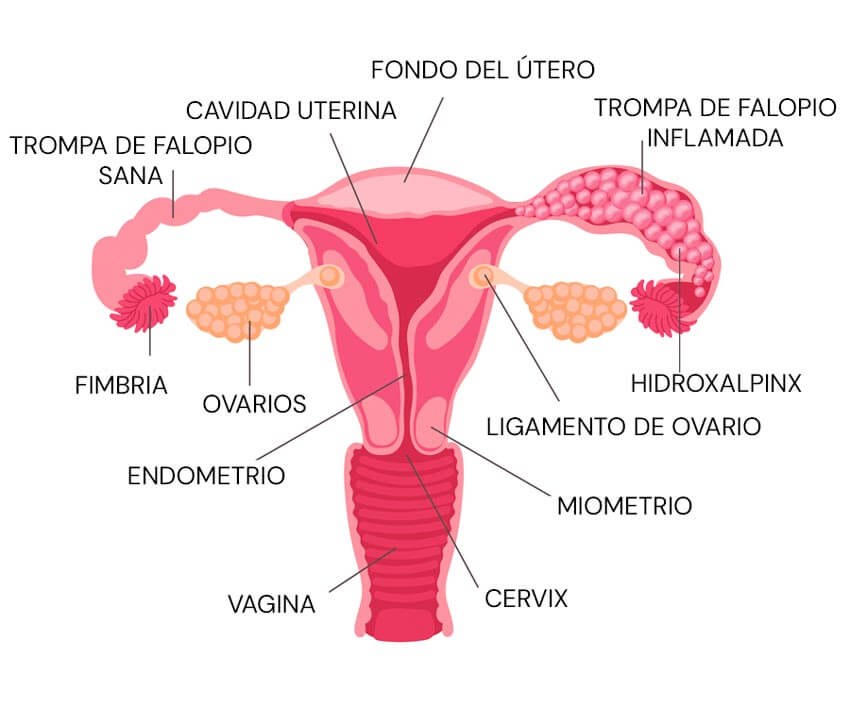 Infografía de las trompas de Falopio y el Hidroxálpinx