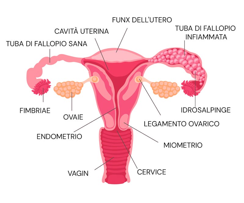 Infografica delle tube di Falloppio e dell'idrossalpinge
