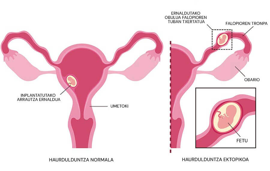 Haurdunaldi ektopikoaren infografia