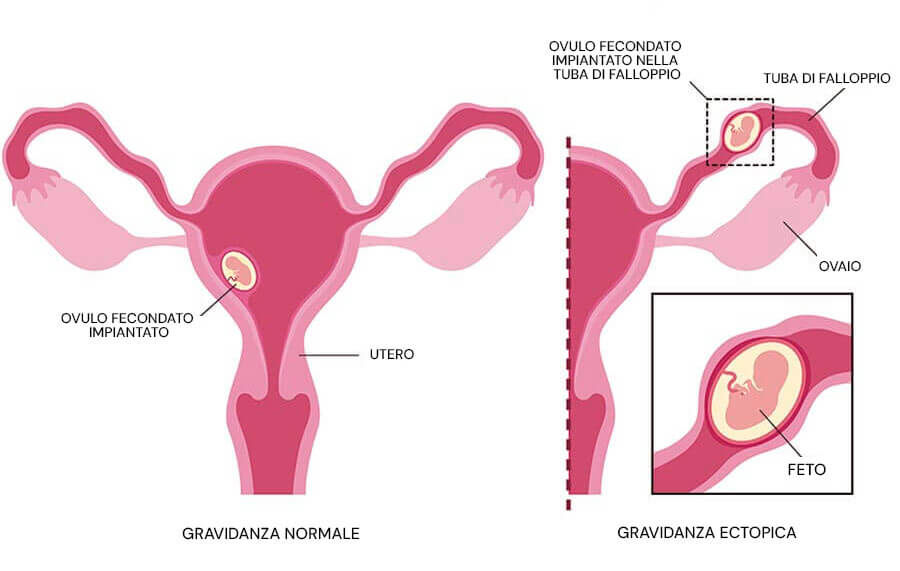 Infografica sulla gravidanza ectopica