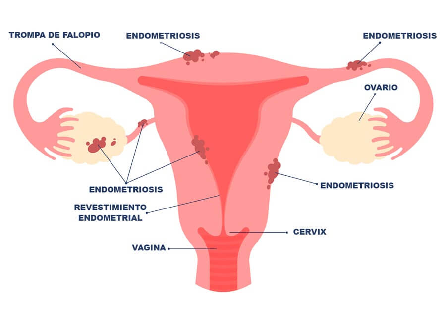 Infografía sobre la endometriosis