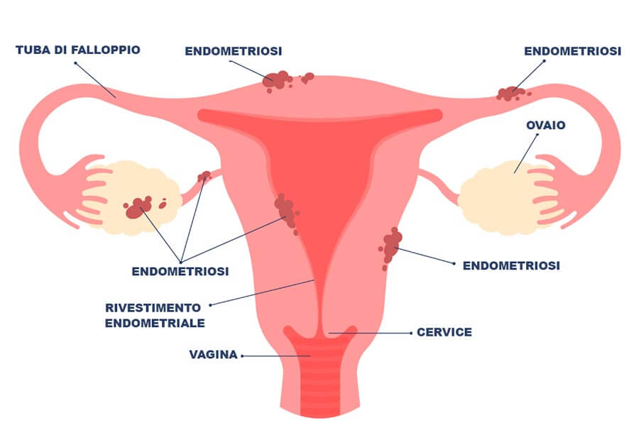 Infografica sull'endometriosi