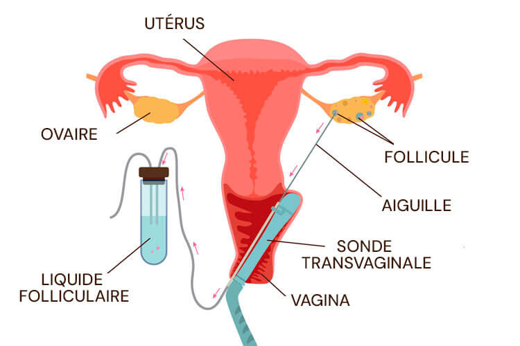 Infographie sur la ponction ovarienne