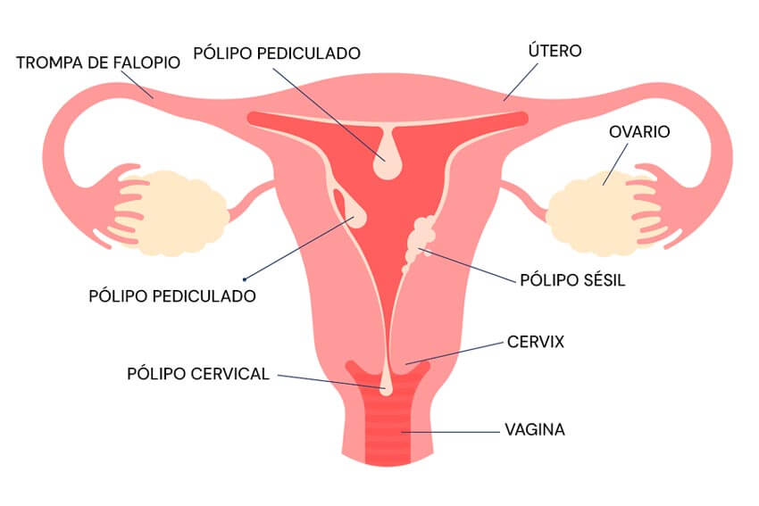 Infografía sobre los pólipos endometriales