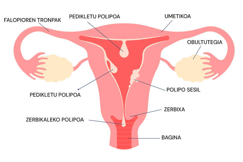 Endometrioko polipoei buruzko infografia