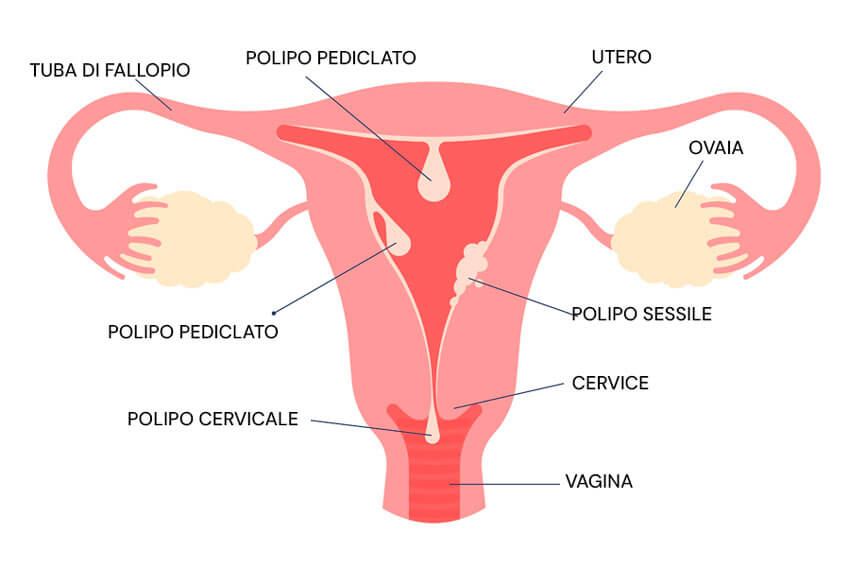 Infografica sui polipi endometriali