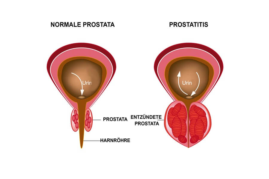 Infografía sobre la prostatitis