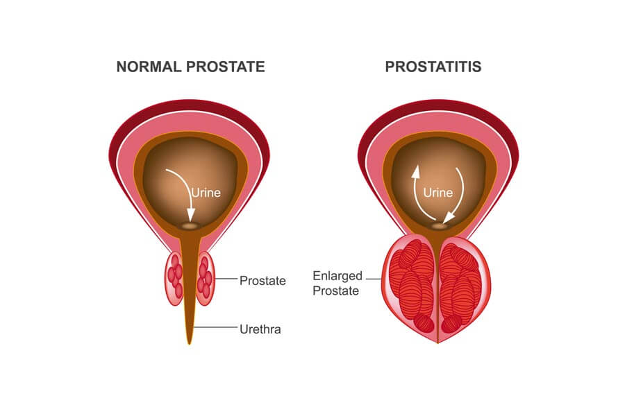 Infographic about prostatitis