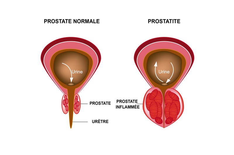 Infographie sur la prostatite