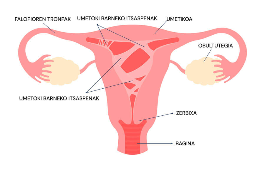 Asherman sindromeari buruzko infografia