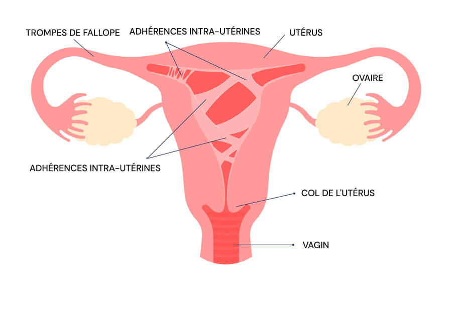 Infographie sur le syndrome d'Asherman