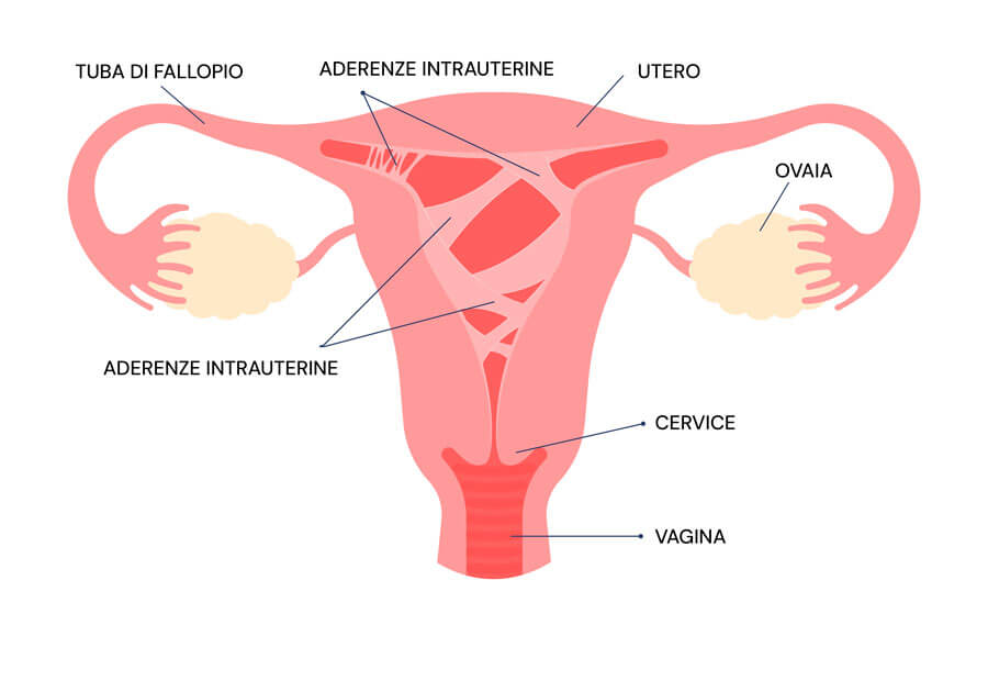 Infografica sulla sindrome di Asherman