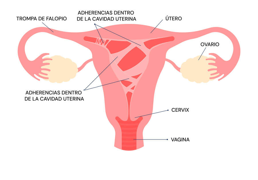 Infografía sobre el síndrome de Asherman
