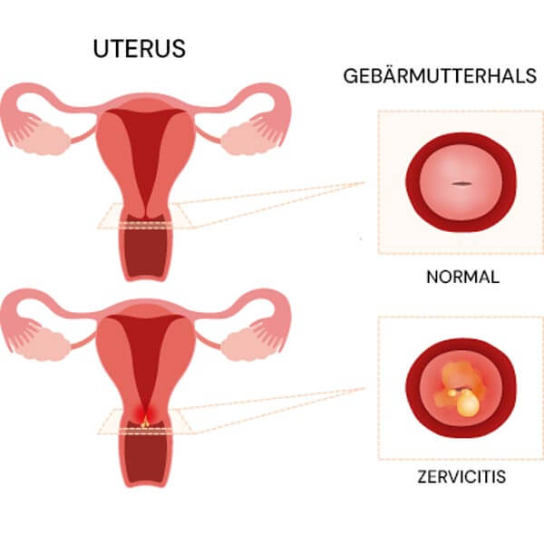 Infografik zur Gebärmutter bei Zervizitis