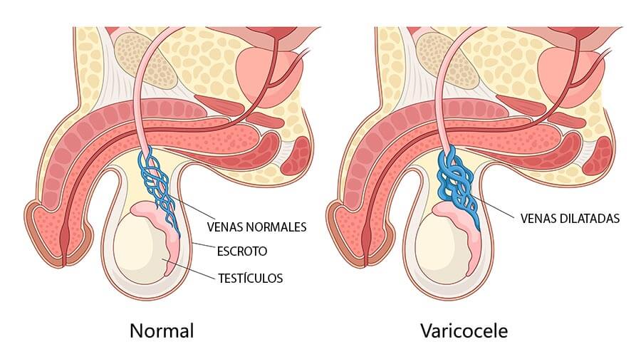 Infografía del varicocele