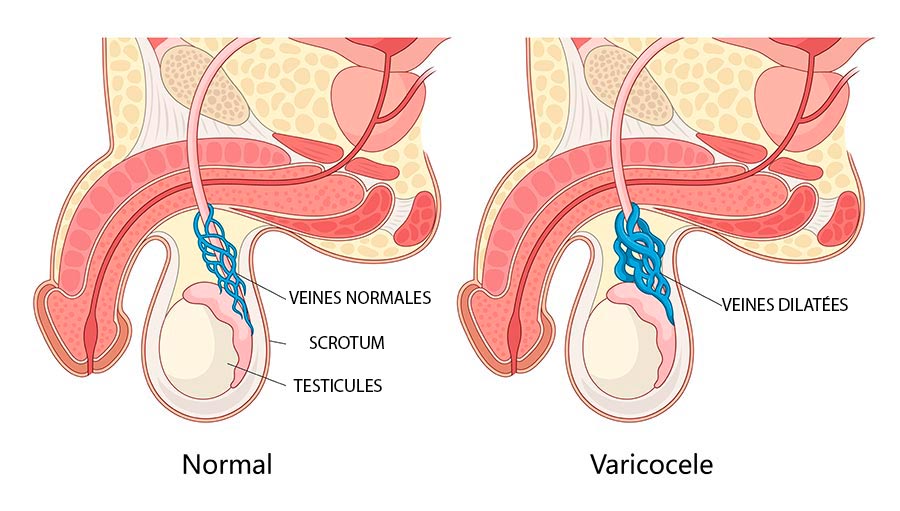 Infographie sur la varicocèle