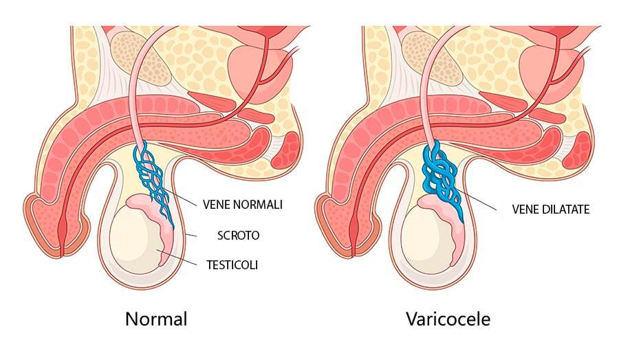 Infografica sul varicocele
