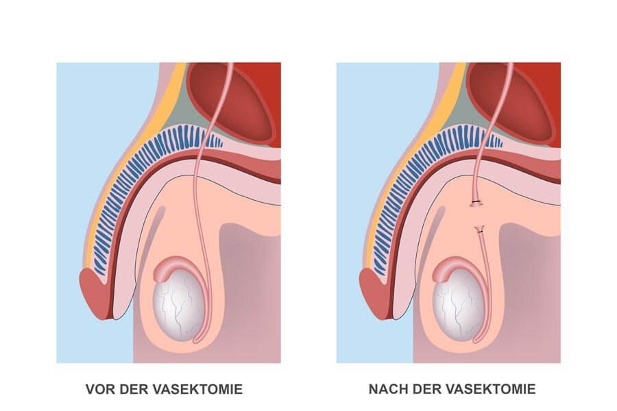 Infografik zur Vasektomie