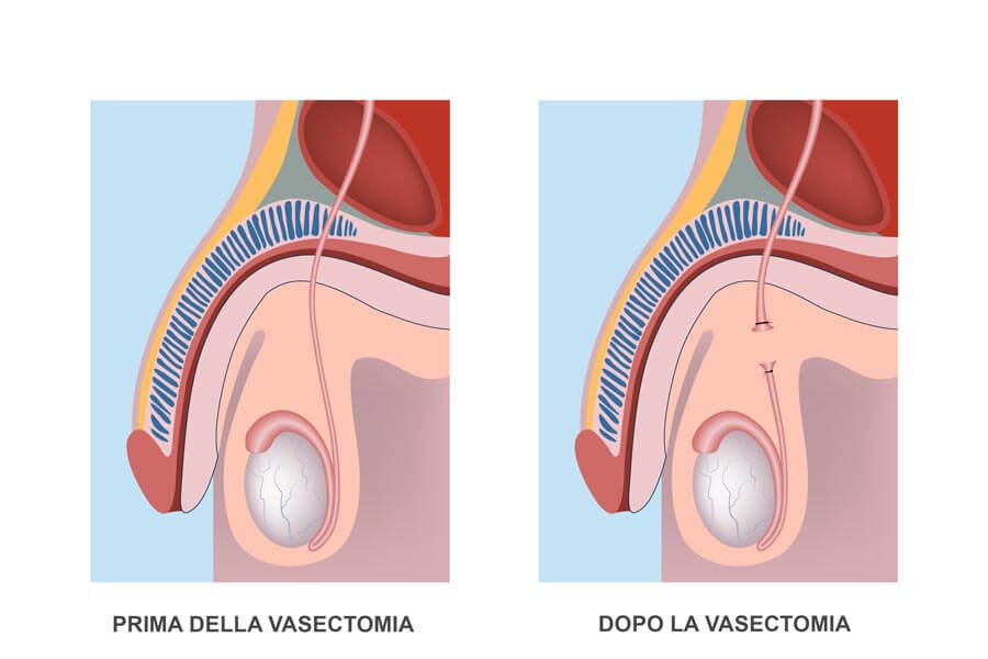Infografica sulla vasectomia