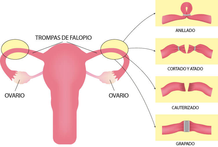 Infografía sobre la ligadura de trompas