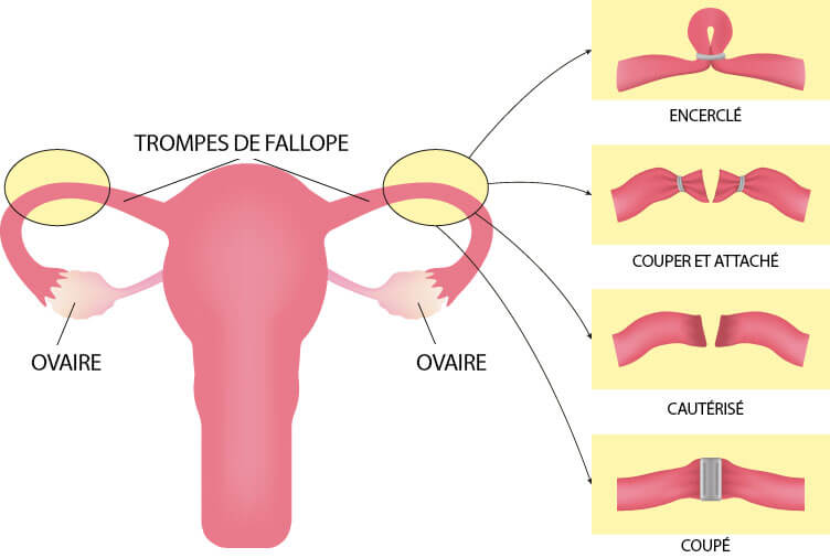 Infographie sur la ligature des trompes