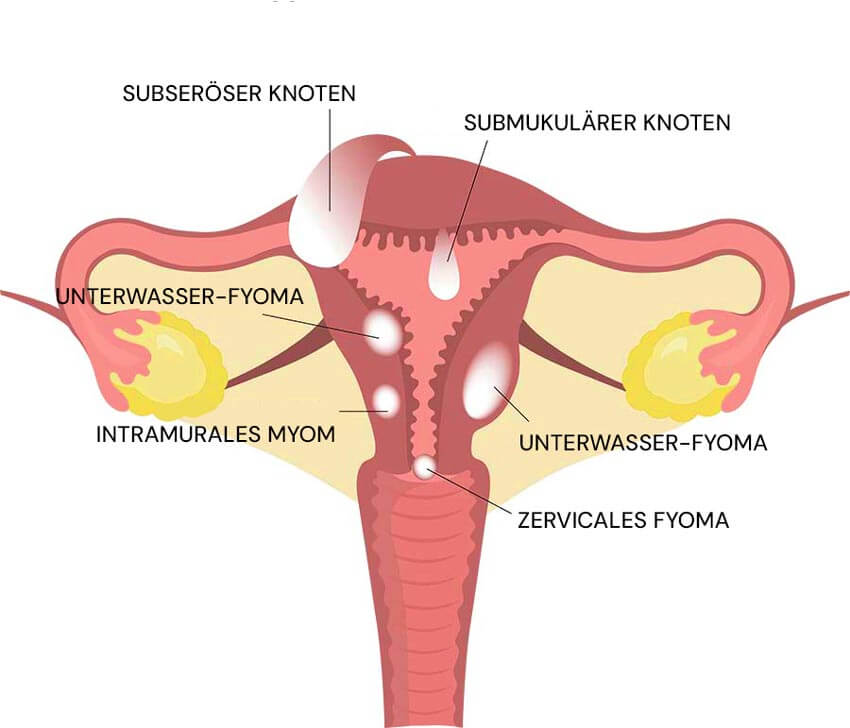 Infografik zu Uterusmyomen