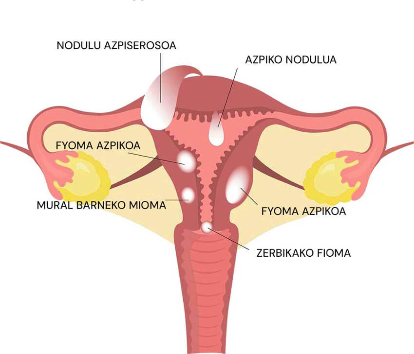 Umetokiko fibromei buruzko infografia