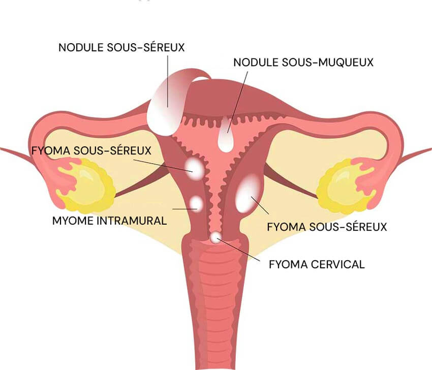 Infographie sur les fibromes utérins