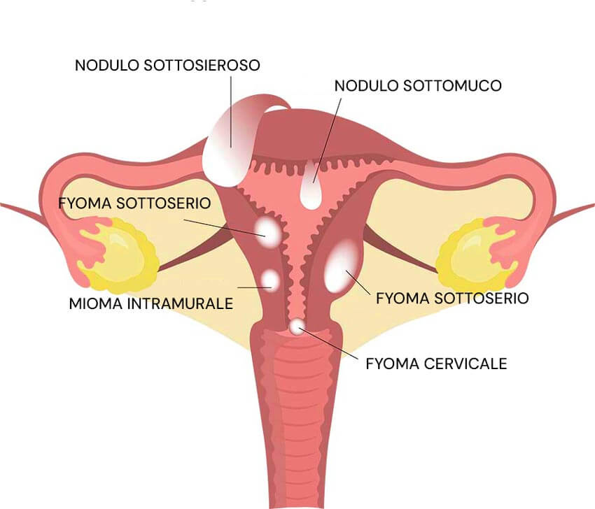 Infografica sui fibromi uterini