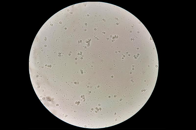 Campione di sperma con azoospermia
