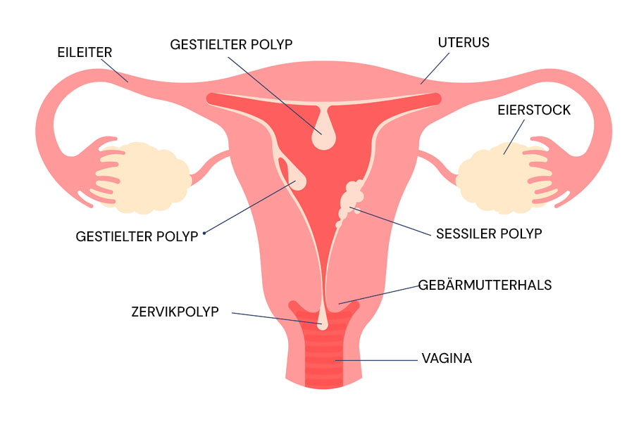 Infografik zu Endometriumpolypen