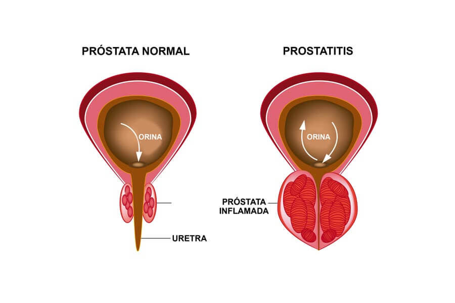 Infografía sobre la prostatitis
