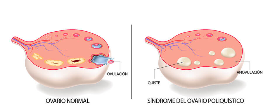Infografía del ovario poliquístico