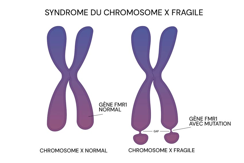 Infographie sur le syndrome de l'X fragile