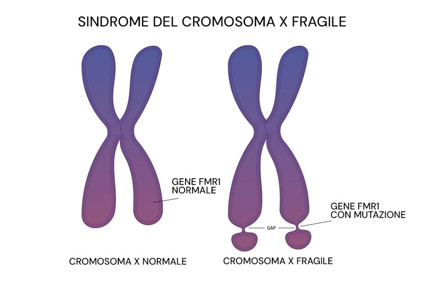 Infografica sulla sindrome dell'X fragile