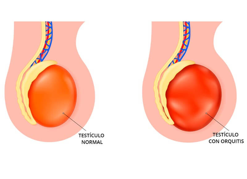 Infografía de la orquitis