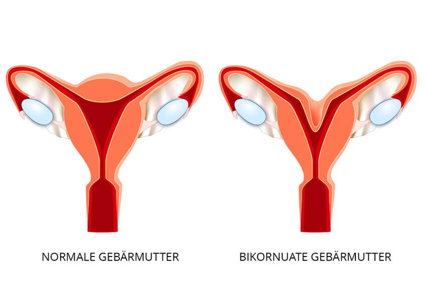 Infografik zum Uterus bicornis